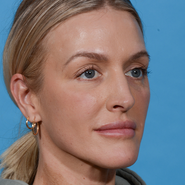 before rhinoplasty female patient angle view case 3529