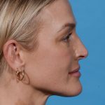 before rhinoplasty female patient side view case 3529