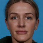 after rhinoplasty female patient front view case 3529