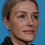 after rhinoplasty female patient angle view case 3529