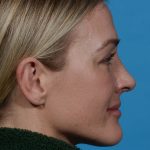 after rhinoplasty female patient side view case 3529