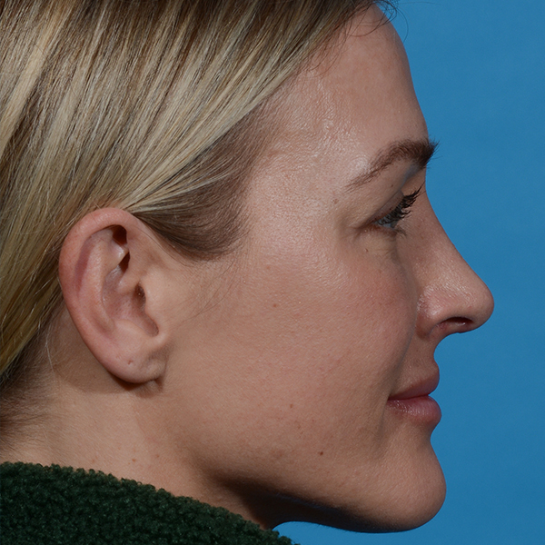 after rhinoplasty female patient side view case 3529