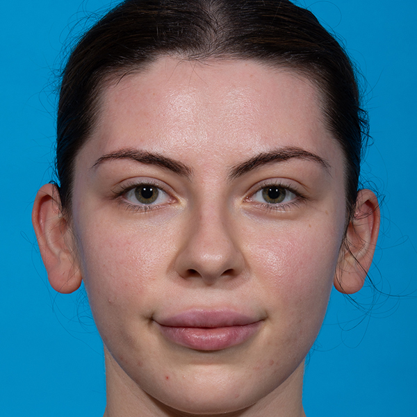before rhinoplasty female patient front view case 3543