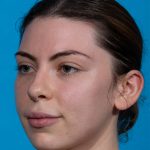 before rhinoplasty female patient angle view case 3543