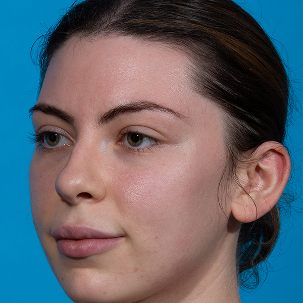 before rhinoplasty female patient angle view case 3543