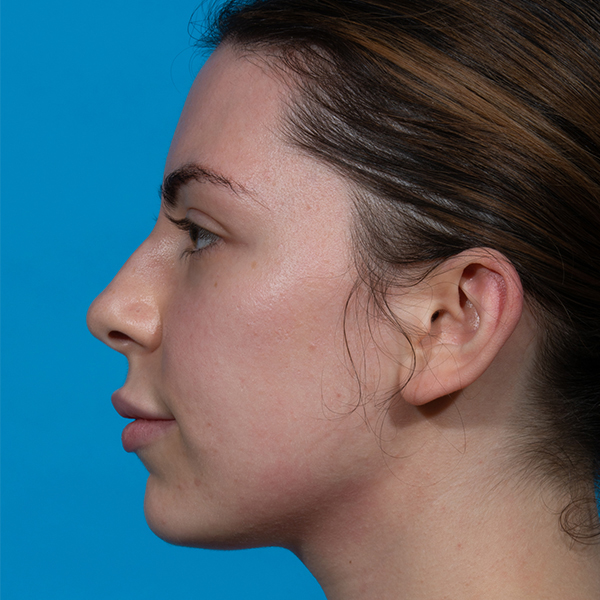 before rhinoplasty female patient side view case 3543