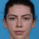 after rhinoplasty female patient front view case 3543