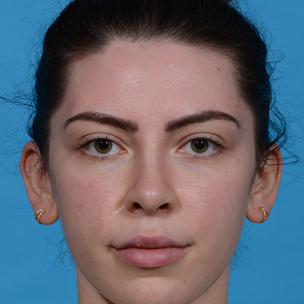 after rhinoplasty female patient front view case 3543