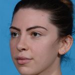 after rhinoplasty female patient angle view case 3543