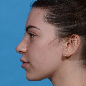 after rhinoplasty female patient side view case 3543