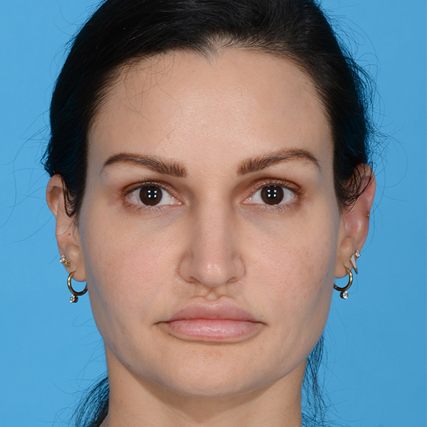 before rhinoplasty female patient front view case 3557