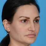 before rhinoplasty female patient angle view case 3557