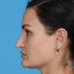 before rhinoplasty female patient side view case 3557