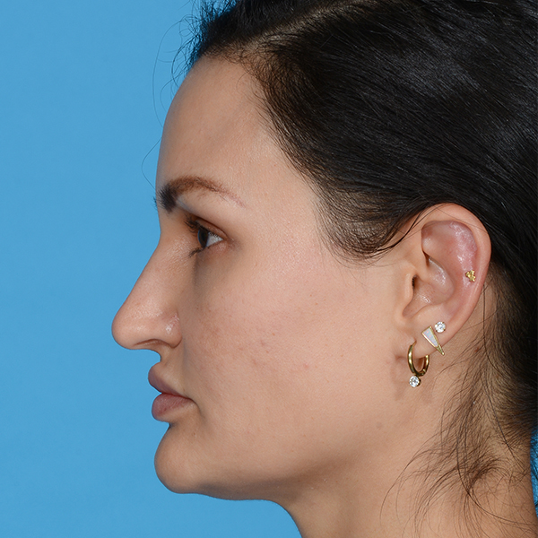 before rhinoplasty female patient side view case 3557