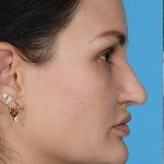 before rhinoplasty female patient right side view case 3557
