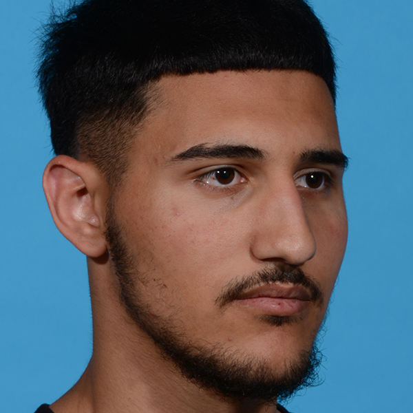 before rhinoplasty male patient angle view case 3536