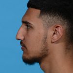 before rhinoplasty male patient side view case 3536