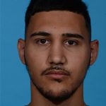 after rhinoplasty male patient front view case 3536