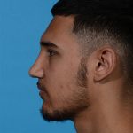 after rhinoplasty male patient side view case 3536