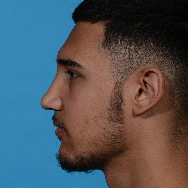 after rhinoplasty male patient side view case 3536