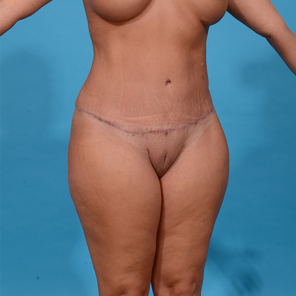 after tummy tuck angle view case 3640