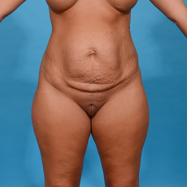 before tummy tuck front view case 3640