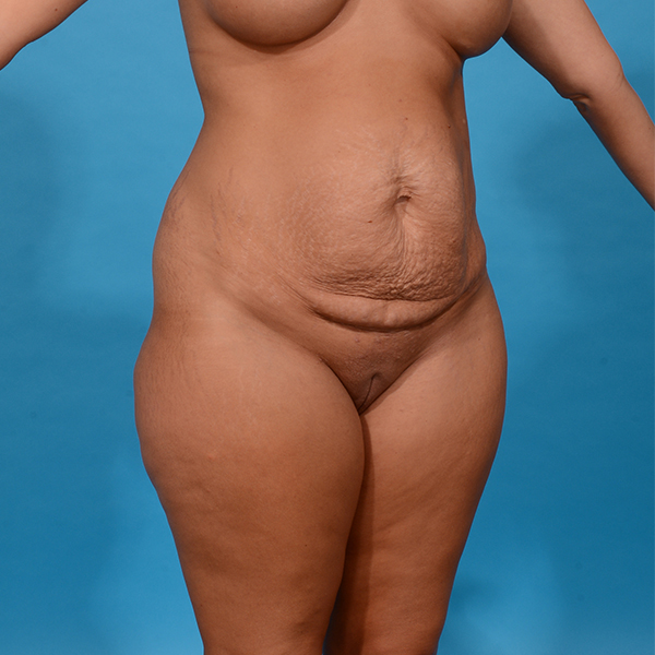 before tummy tuck angle view case 3640