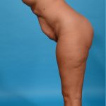 before tummy tuck side view bent case 3640