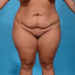before tummy tuck front view case 3649