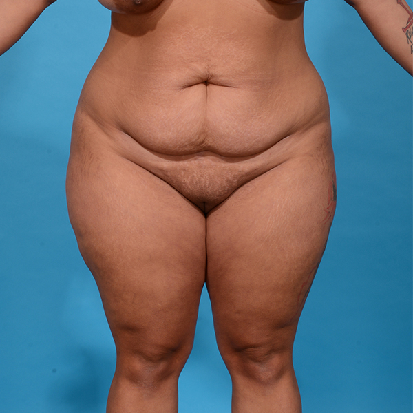 before tummy tuck front view case 3649