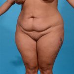 before tummy tuck angle view case 3649