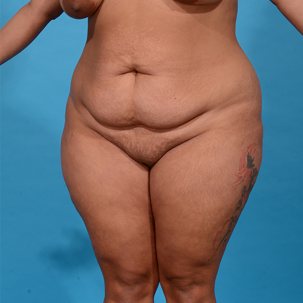 before tummy tuck angle view case 3649