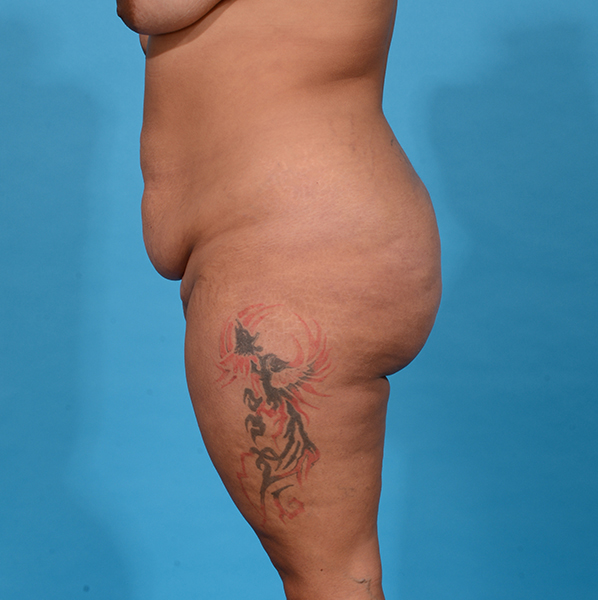 before tummy tuck side view case 3649