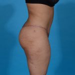 after tummy tuck side view case 3667