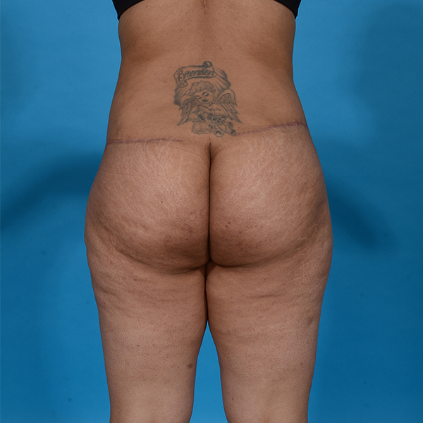 after tummy tuck back view case 3667
