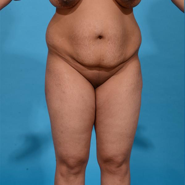 before tummy tuck front view case 3667