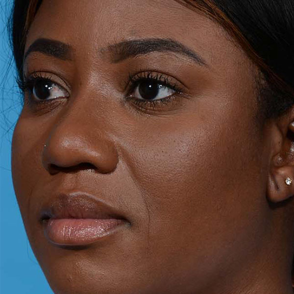 after rhinoplasty angle view female patient case 3833