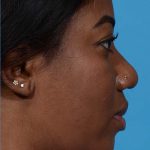 after rhinoplasty side view female patient case 3833