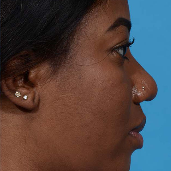 after rhinoplasty side view female patient case 3833