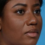 after rhinoplasty angle view female patient case 3833