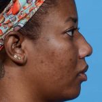 before rhinoplasty side view female patient case 3833