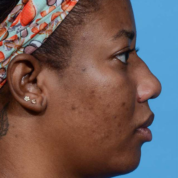 before rhinoplasty side view female patient case 3833