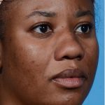 before rhinoplasty angle view female patient case 3833