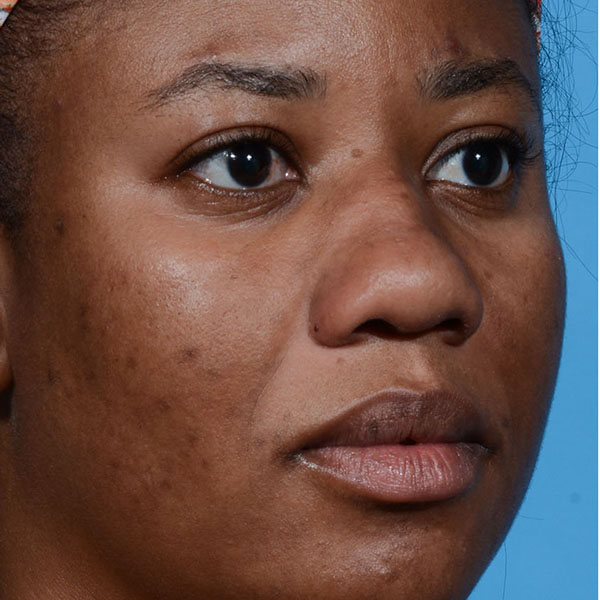before rhinoplasty angle view female patient case 3833