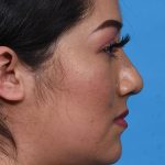 after rhinoplasty side view female patient case 3856