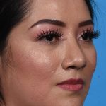 after rhinoplasty angle view female patient case 3856