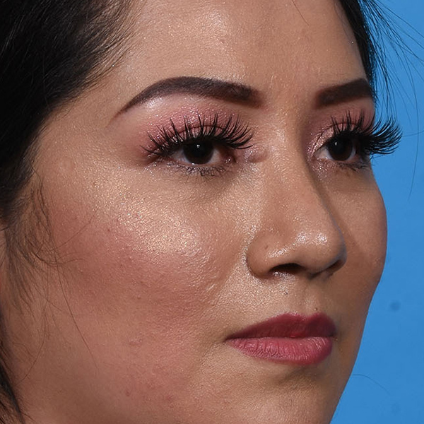 after rhinoplasty angle view female patient case 3856