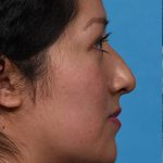 before rhinoplasty side view female patient case 3856