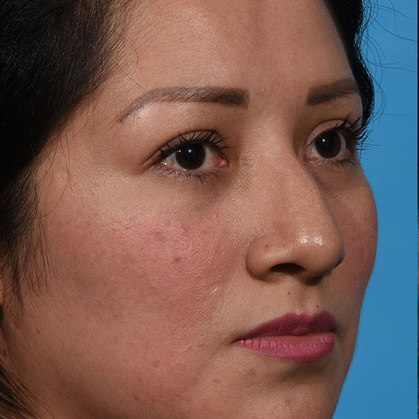 before rhinoplasty angle view female patient case 3856
