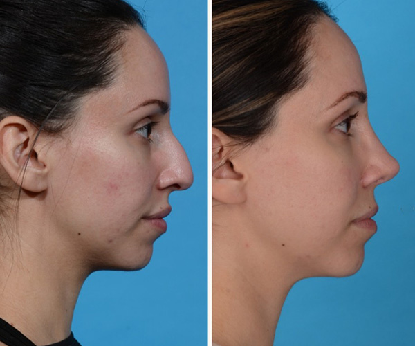 Yash-Rhinoplasty-Results-Houston